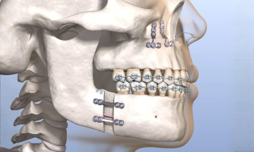 Cirugia Bucal Ortognatica y Facial