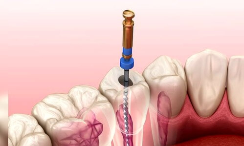 Endodoncia
