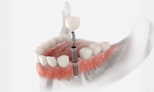 Implantes dentales