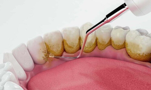 Periodoncia